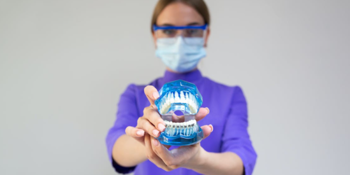 Materials Material: Exploring Different Types of Total Mouth Implant Options